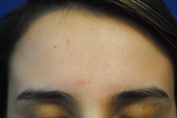 la nouvelle10 chemical peel medical spa oxnard forehead day 7 