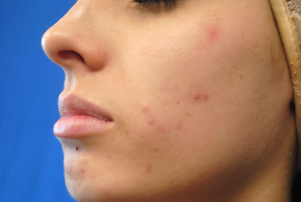 la nouvelle10 chemical peel medical spa oxnard  left cheek before 