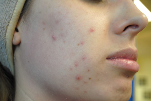 la nouvelle10 chemical peel medical spa oxnard right cheek before 