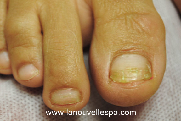 laser genesis for treating of toenails la nouvelle spa oxnard