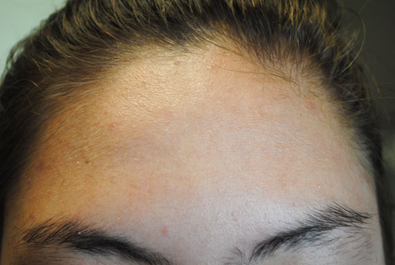 laser genesis and la nouvelle acne line on female forehead by  la nouvelle spa oxnard, before