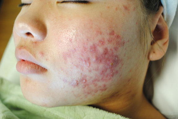laser genesis and la nouvelle acne line on female forehead by  la nouvelle spa oxnard, before