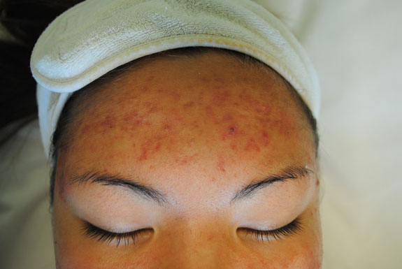 laser genesis and la nouvelle acne line on female forehead by  la nouvelle spa oxnard, before