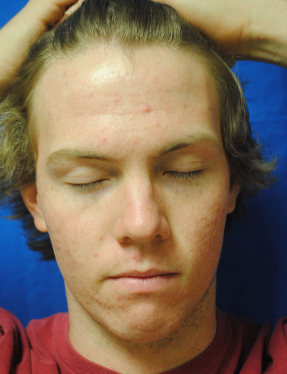 laser genesis and la nouvelle acne line on male face by  la nouvelle spa oxnard, before