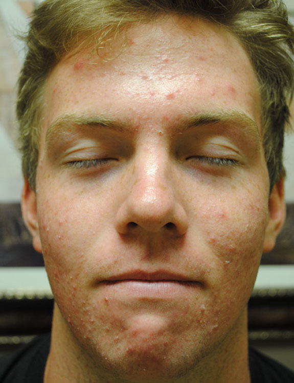 laser genesis and la nouvelle acne line on male face by  la nouvelle spa oxnard, before