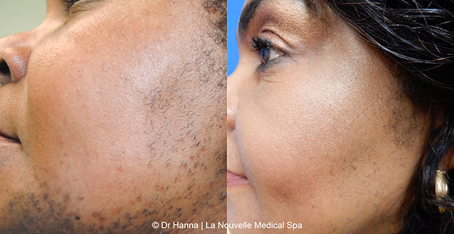 Laser hair removal treatments before and after Ventura County, La Nouvelle Medical Spa, Oxnard
