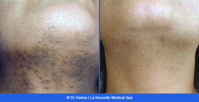 Laser hair removal treatments before and after Ventura County, La Nouvelle Medical Spa, Oxnard