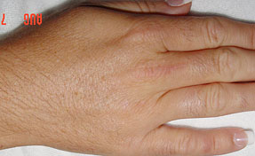 Laser Hair Removal on hand - before