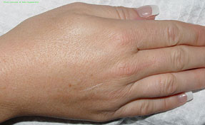 Laser Hair Removal on hand- after