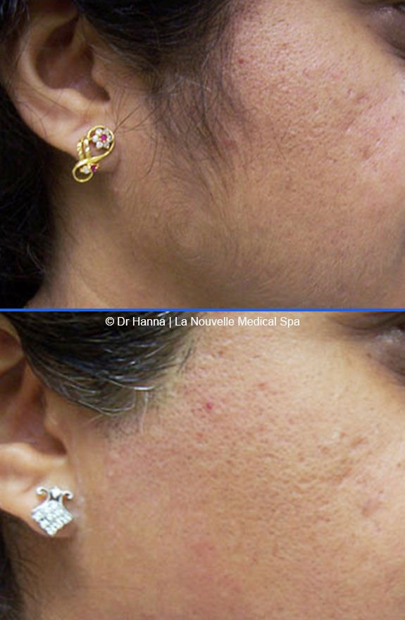 laser hair removal on cheek before after photos, La Nouvelle Medical Spa, Oxnard, Ventura county  