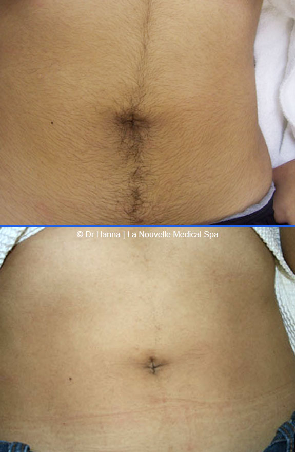 laser hair removal abdomen before after photos, La Nouvelle Medical Spa, Oxnard, Ventura county  
