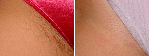 laser hair removal before and after oxnard ventura county