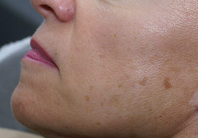 IPL laser treatment - browns spots before
