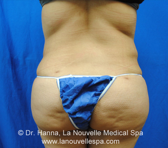 liposuction on back by dr hanna la nouvelle spa oxnard