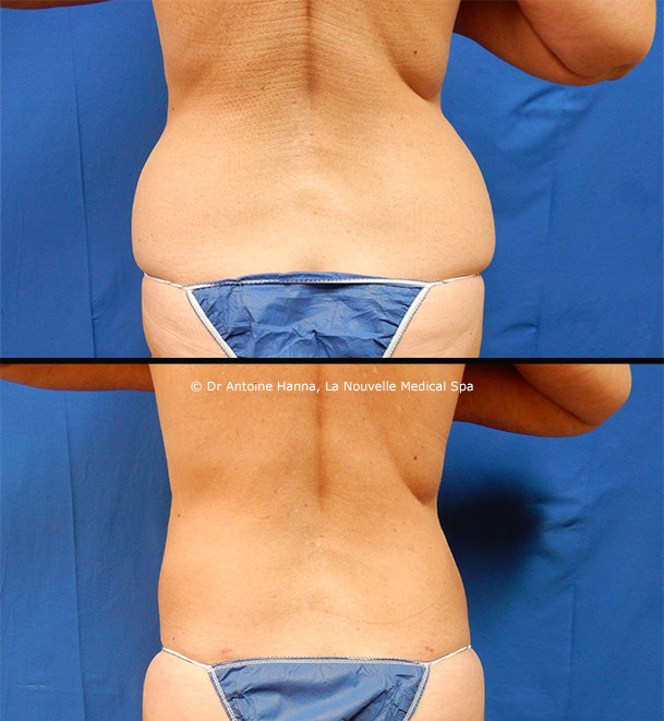liposuction on back by dr hanna la nouvelle spa oxnard