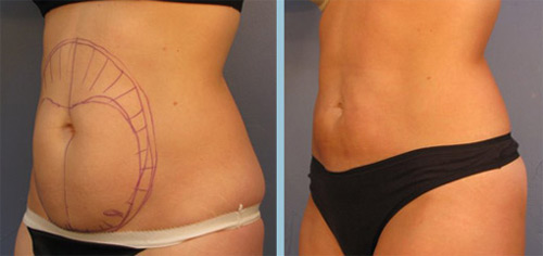 Liposuction before and after