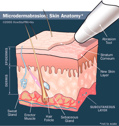 Microdermabrasion scheme