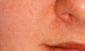 Microdermabrasion - after
