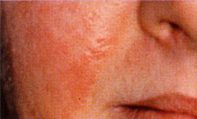 Microdermabrasion- before