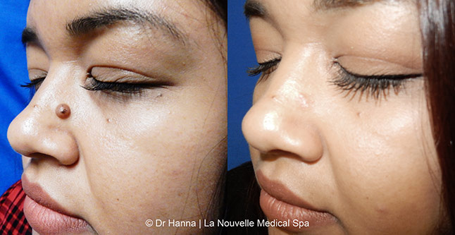 Leison and mole removal before after photos by dr. Hanna, La Nouvelle Medical Spa, Oxnard, Ventura County 