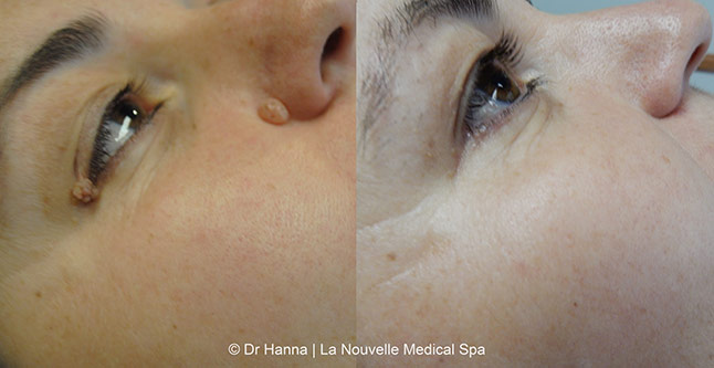 Leison and mole removal before after photos by dr. Hanna, La Nouvelle Medical Spa, Oxnard, Ventura County 