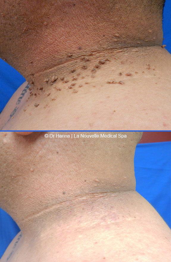 mole leison removal by dr hanna la nouvelle medical spa oxnard ventura