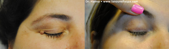 mole leispn removal by dr hanna la nouvelle medical spa oxnard ventura