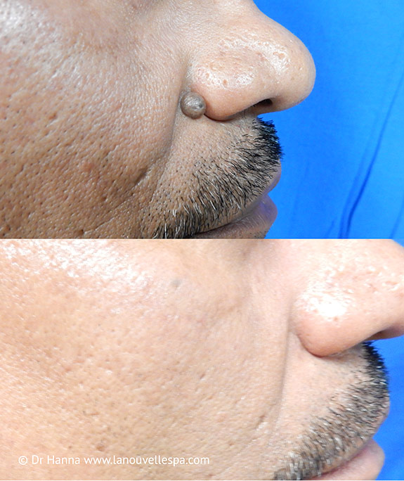 mole leison removal by dr hanna la nouvelle medical spa oxnard ventura