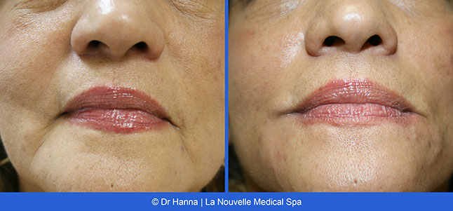Radiesse, Juvederm, Voluma Before and After photos Ventura County by Dr. Antoine Hanna and Dr. Jack Shenouda, La Nouvelle Medical Spa