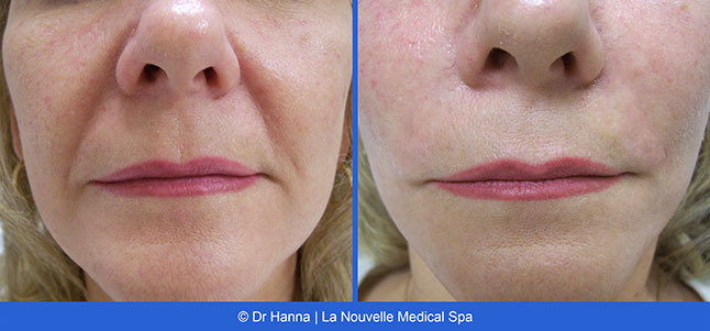 Radiesse, Juvederm, Voluma Before and After photos Ventura County by Dr. Antoine Hanna and Dr. Jack Shenouda, La Nouvelle Medical Spa