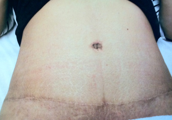 abdominoplasty incision after scar treatment ventura