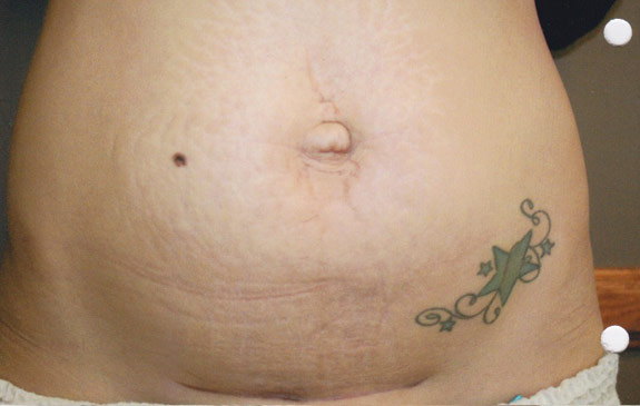 abdominoplasty incision scar treatments ventura