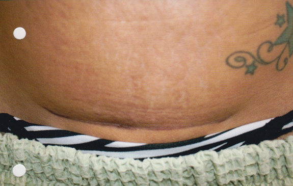 abdominoplasty incision scar treatments ventura