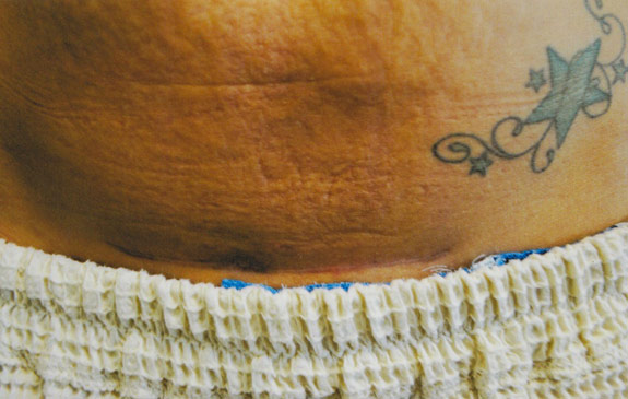 abdominoplasty incision scar treatments ventura