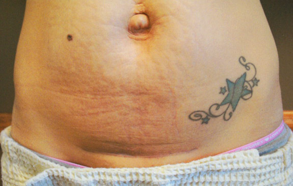 abdominoplasty incision scar treatments ventura