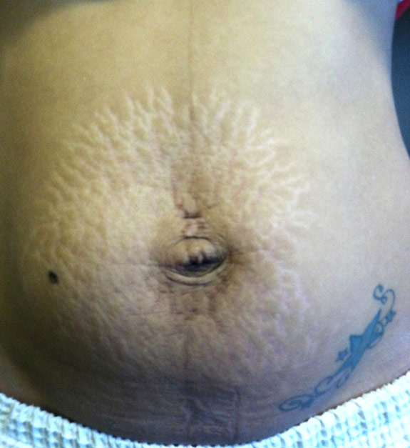 stretch marks, loose skin treatments ventura before