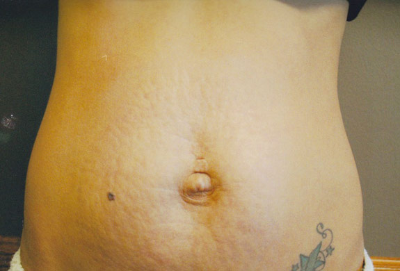 stretch marks, loose skin treatments ventura after