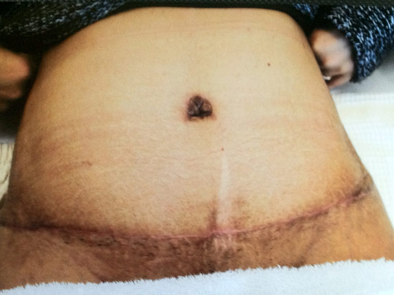 abdominoplasty incision before scar treatment ventura