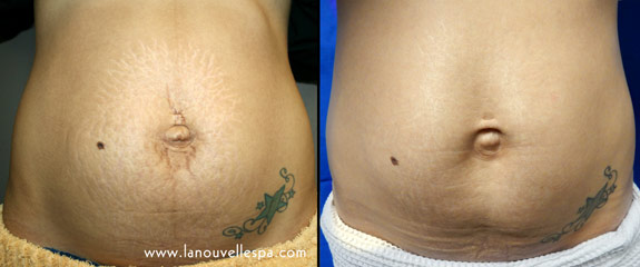 abdominoplasty incision before scar treatment ventura