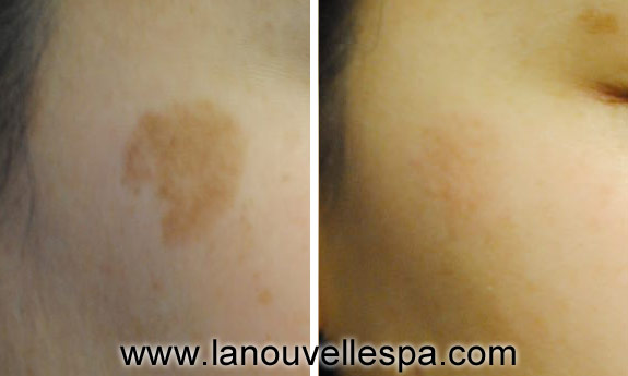 obagi products by dr hanna la nouvelle spa oxnard before