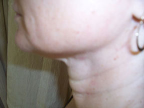 fillers, radiesse, juvederm, restylane before and after