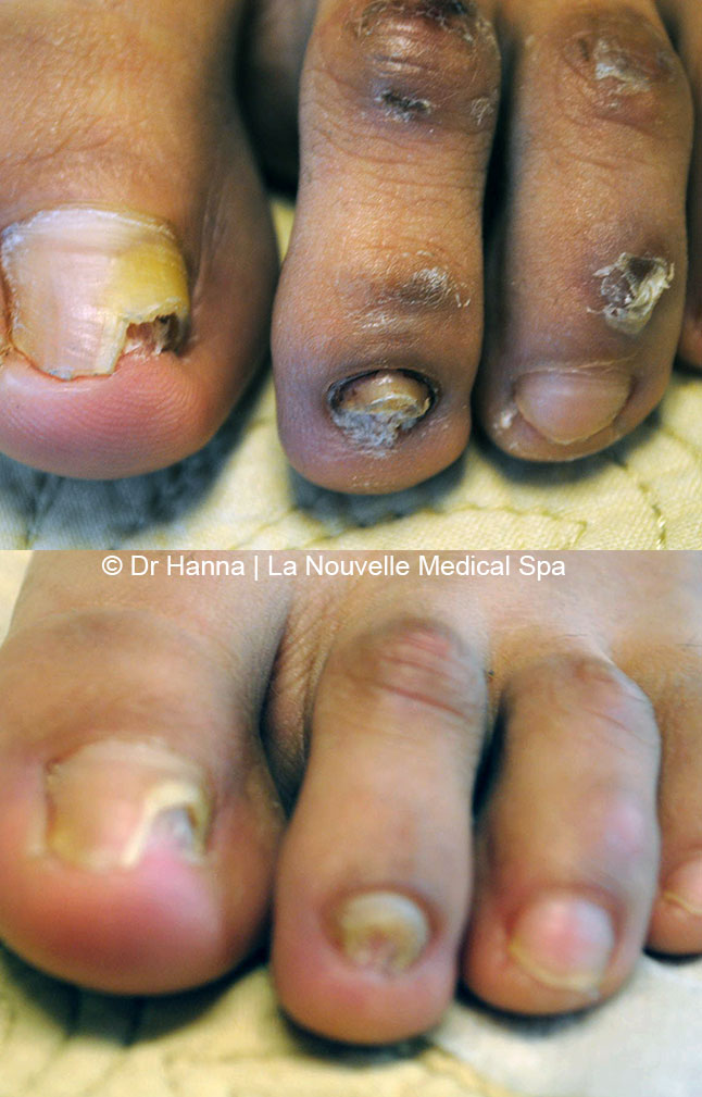 laser genesis for treating of toenails la nouvelle spa oxnard