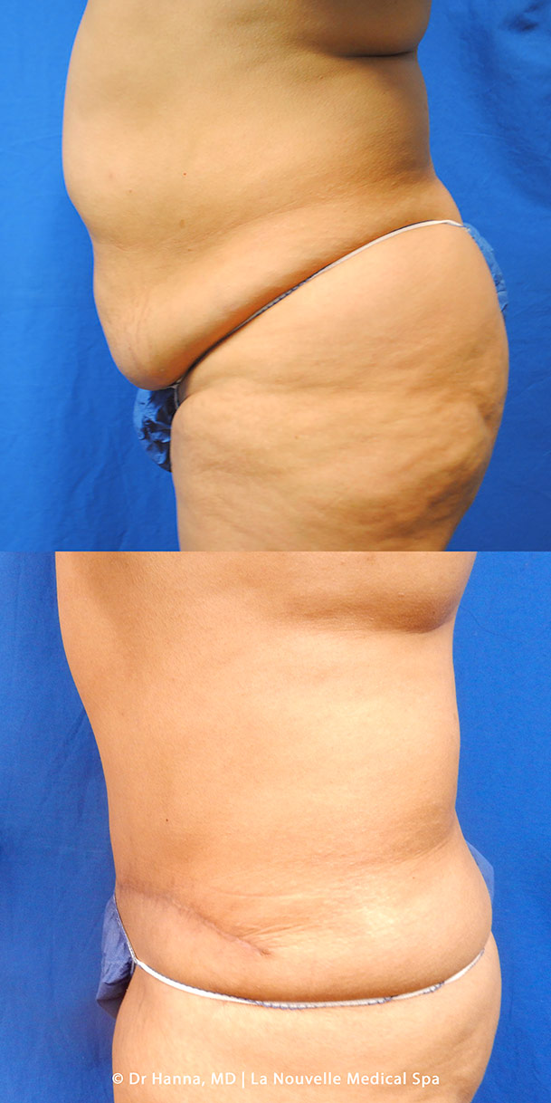 abdominoplasty tummy tuck  before after by dr antoine hanna la nouvelle medical spa ventura