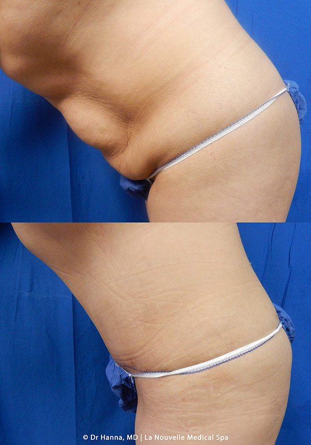 abdominoplasty tummy tuck  before after by dr antoine hanna la nouvelle medical spa ventura