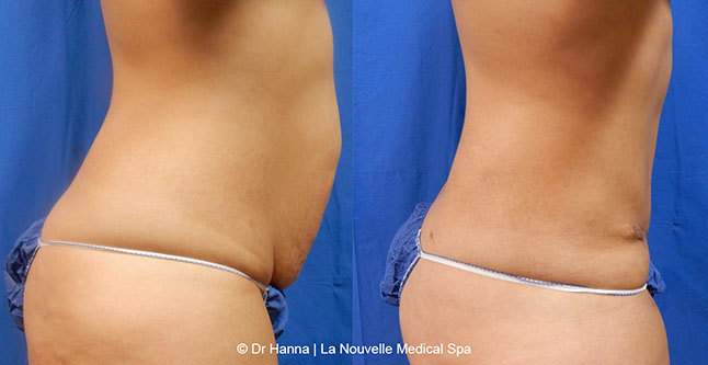Tummy Tuck Ventura County, Abdominosplasty Before and After Photos by Dr. Hanna, La Nouvelle Medical Spa, Oxnard