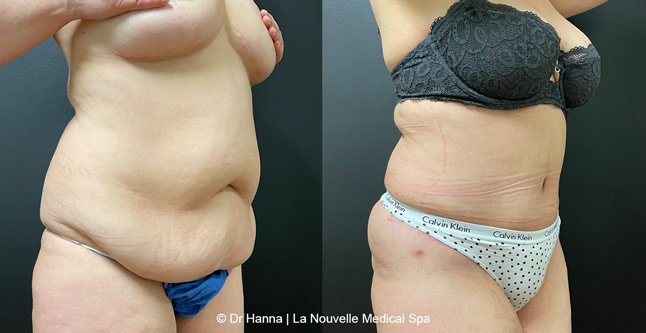 Tummy Tuck Before & After Ventura County, Abdominosplasty by Dr. Hanna, La Nouvelle Medical Spa, Oxnard