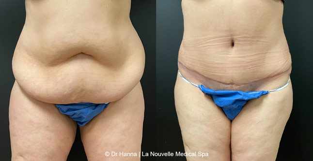 Tummy Tuck Before & After Ventura County, Abdominosplasty by Dr. Hanna, La Nouvelle Medical Spa, Oxnard