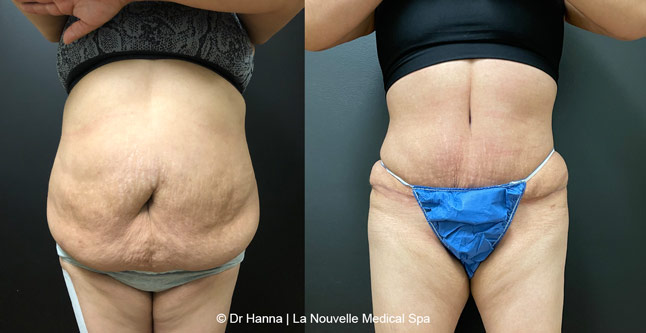Tummy Tuck Ventura County, Abdominosplasty Before and After Photos by Dr. Hanna, La Nouvelle Medical Spa, Oxnard