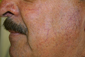 Varicose and Spider Vein Treatments - Before and After