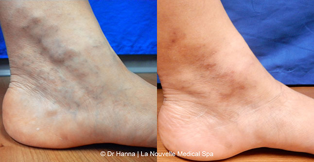 Varicose Vein Removal with Phlebectomy before after photos, Dr. Hanna La Nouvelle Medical Spa, Oxnard, Ventura County